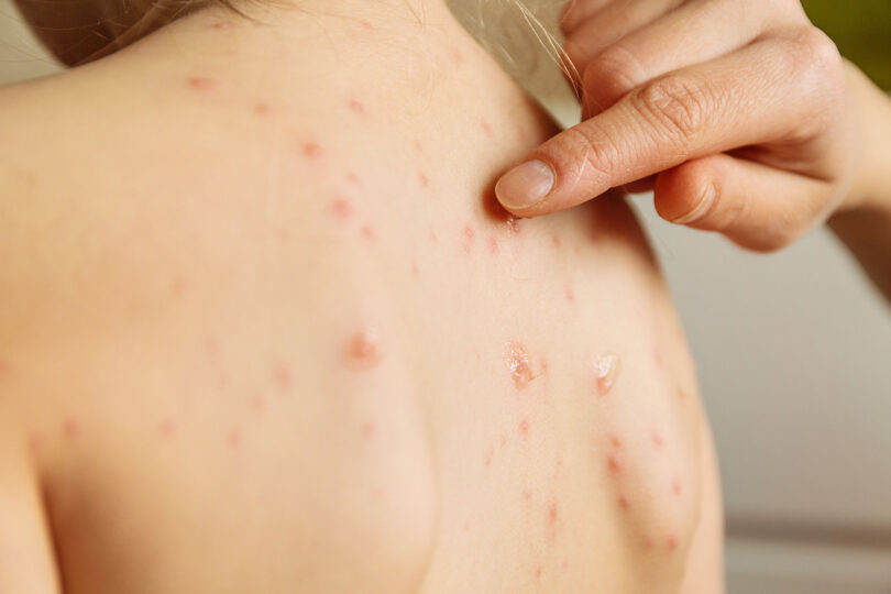 A child's back is shown with chickenpox spots while a parent applies medication to one of the spots.